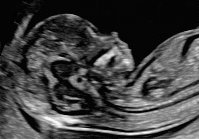 Nuchal Translucency - NTScan - Early Anomaly Scan.